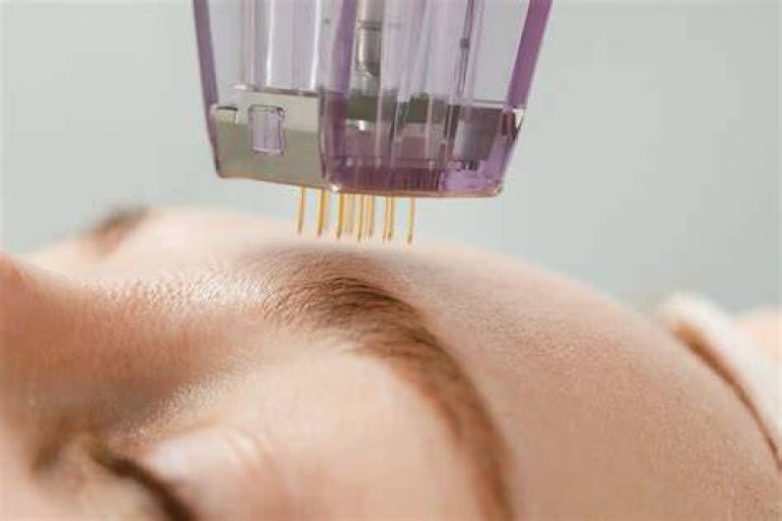 Can estheticians microneedle?
