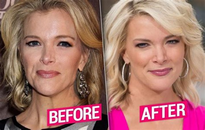 Megyn Kelly Facelift